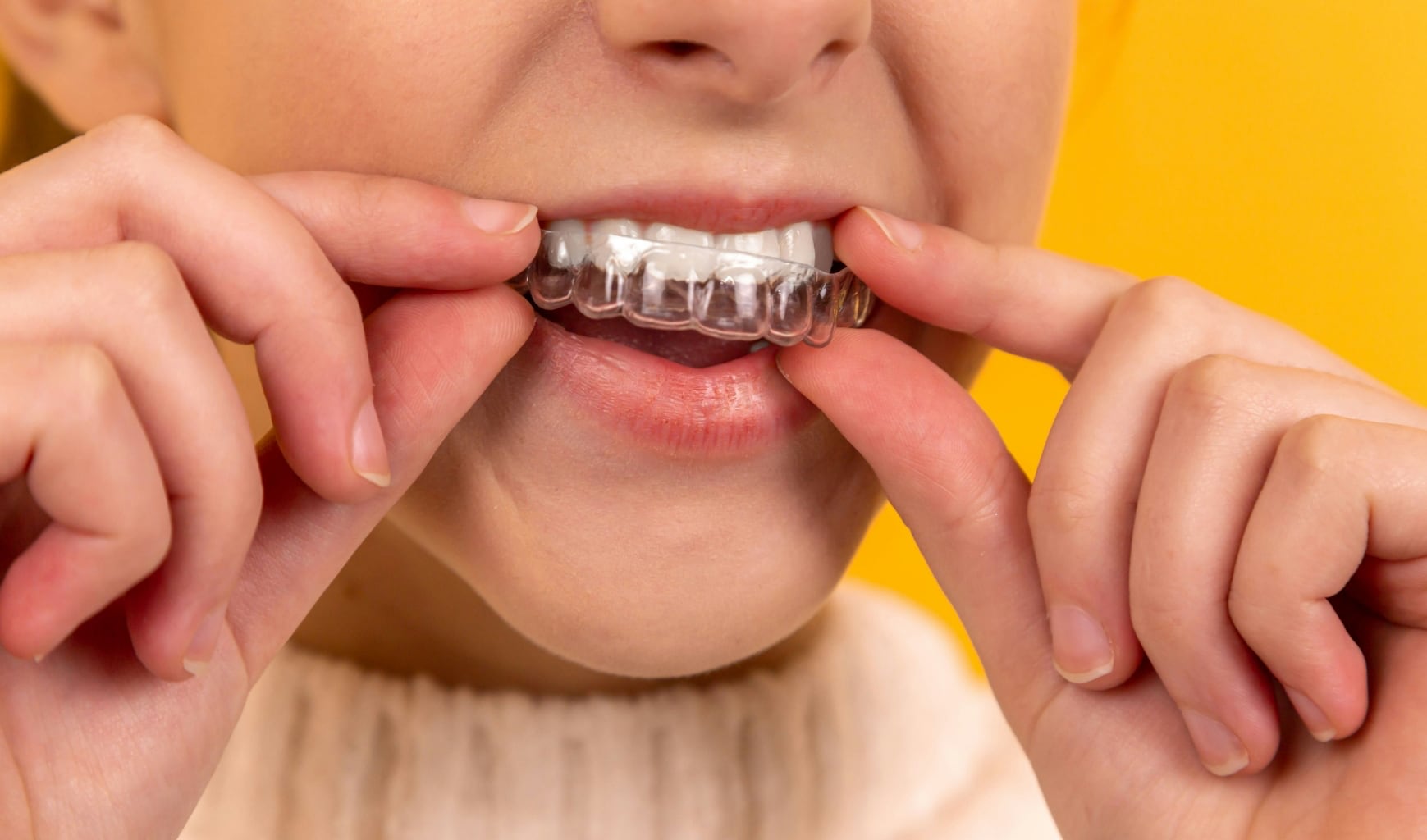 Eine junge Frau die sich ihre Zahnschiene auf die Zähne legt